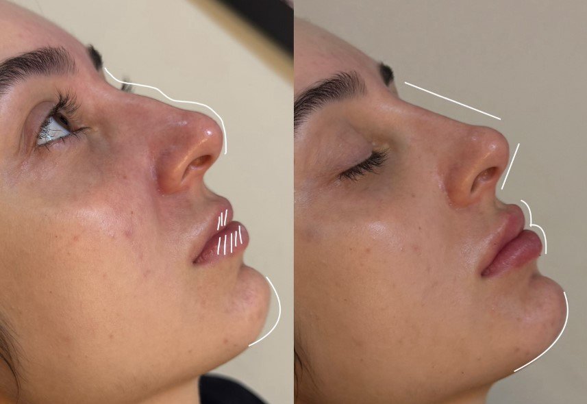 rinoplastia-harmonizacao-facial-nariz-anapolis-go